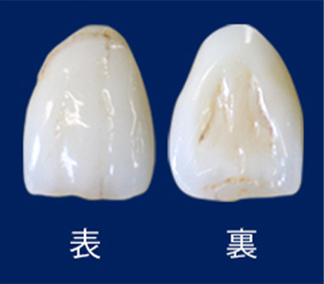 ジルコニアセラミック