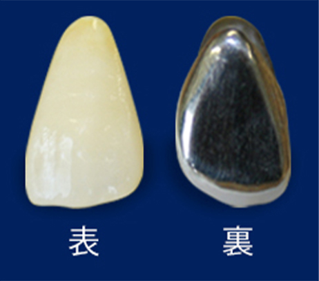 プラスティック前装冠