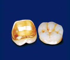 メタルセラミック