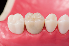 メタルセラミック