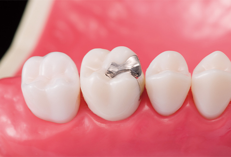 金銀パラジウム合金