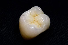 オールセラミック